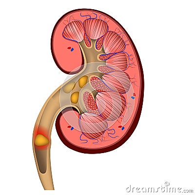 Renal colic. the formation of stones in the organs. Vector Illustration